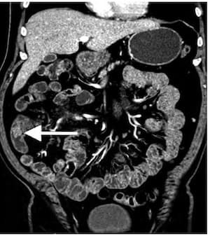 КТ энтерография тонкого кишечника снимок